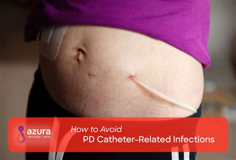 Pd Catheter Care: Preventing Infections Easily