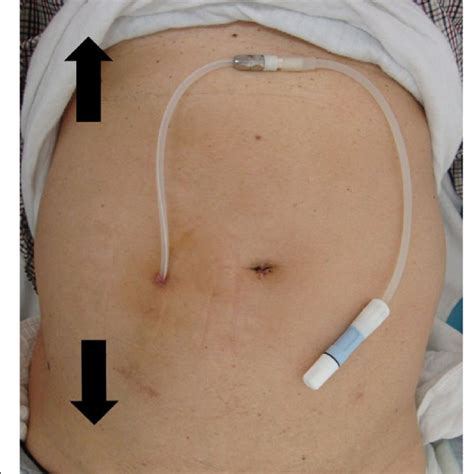 Pd Dialysis Catheter