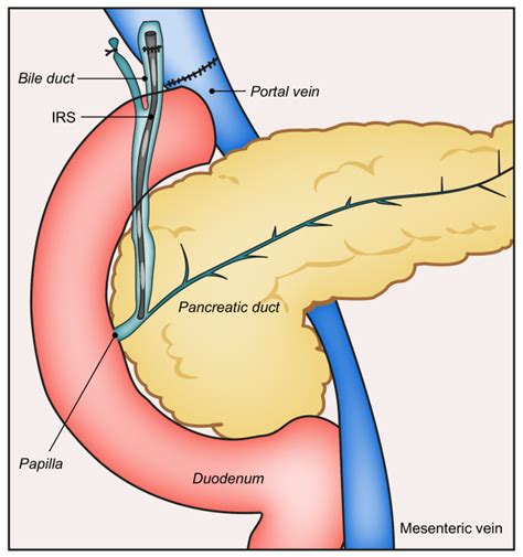 Pdf Duct To Duct Biliary Reconstruction With Or Without An