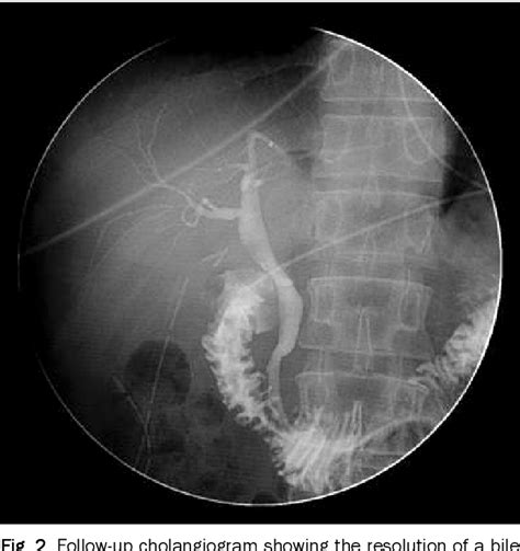 Pdf Endoscopic Nasobiliary Drainage For Bile Leak Caused By Injury To