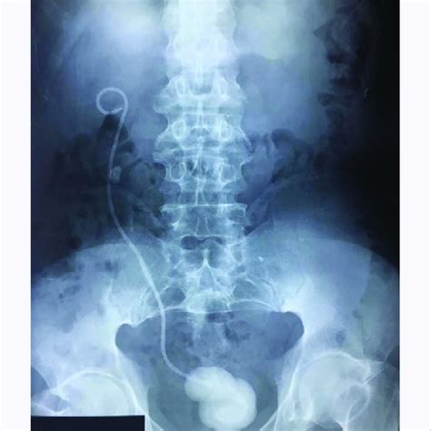 Pdf Removal Of A Double J Stent Not Always A Simple Procedure