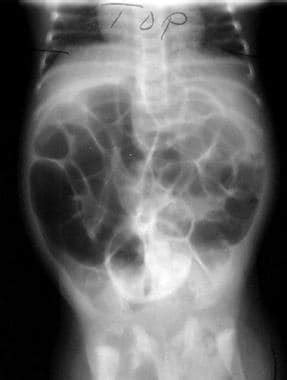 Pediatric Small Bowel Obstruction Background Pathophysiology Etiology