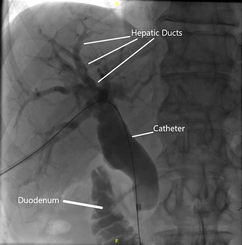 Percutaneous Transhepatic Cholangiogram