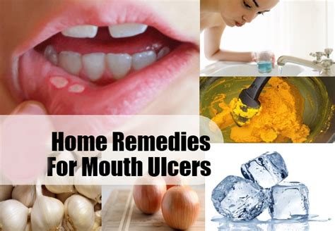 Perfect Home Remedies For Mouth Ulcers Life Health Max