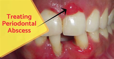 Periodontium Abscess: Find Effective Treatment Solutions