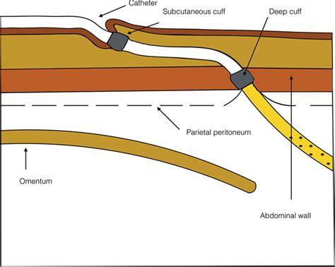 Peritoneal Dialysis Catheter Placement And Management Intechopen