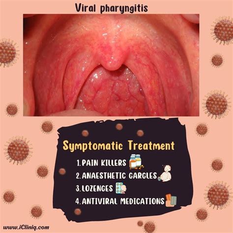 Pharyngitis Wikipedia