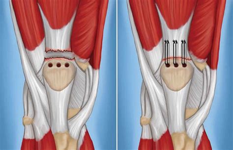 Physical Therapy And Quadriceps Tendon Rupture Quadriceps Tendon