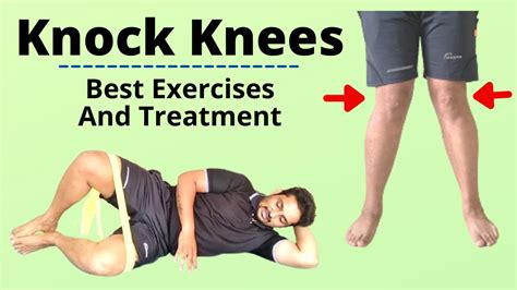 Physical Therapy Exercises For Knock Knees At Eleanor Welch Blog