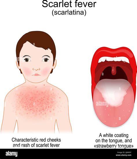 Pictures Of Scarlatina