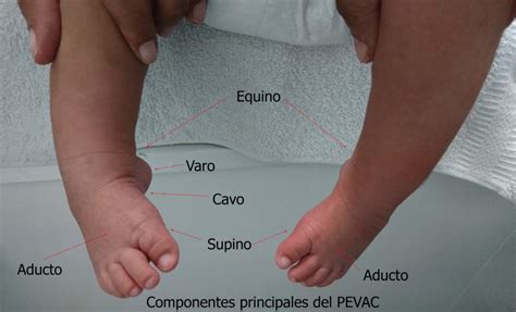 Pie Equino Varo Guide: Corrective Surgery Options