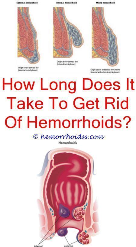 Pin On Hemorrhoids During Pregnancy