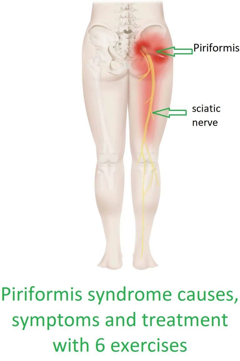 Piriformis Syndrome Causes And Treatment With 6 Exercises