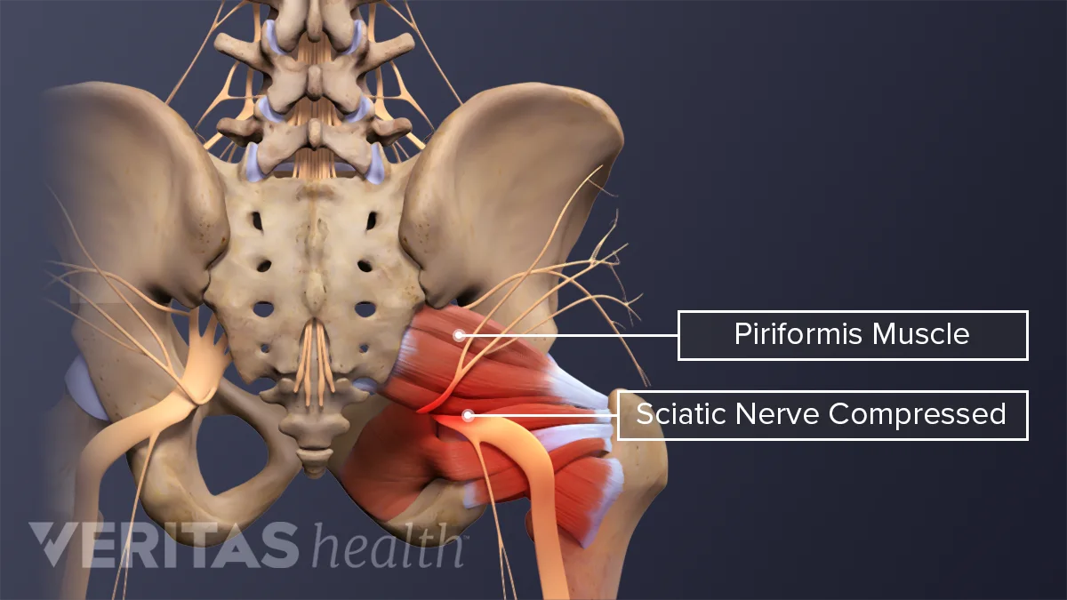 Piriformis Syndrome Treatment Causes Symptoms Qi Spine