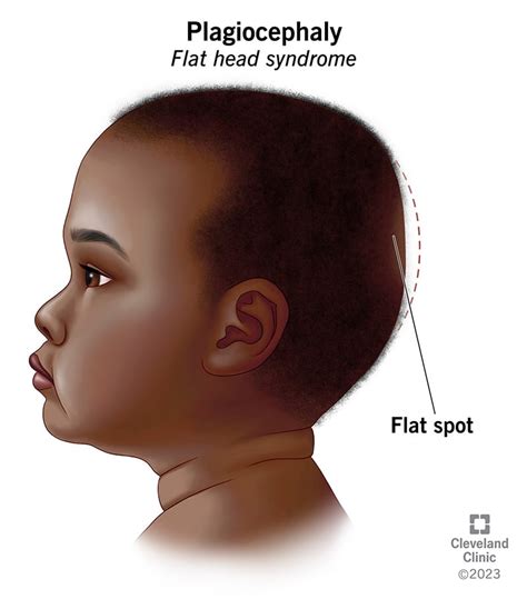 Plagiocephaly, Positional Plagiocephaly, Flat Head, 45% Off