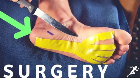 Plantar Fasciitis Surgery A Runner S Story Youtube