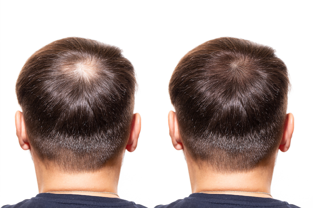 Platelet Rich Plasma Prp For Hair Loss Does It Work Ultimate Guide