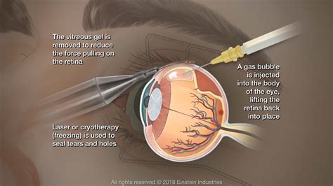 Post Detached Retina Surgery: Heal Safely