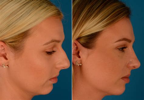 Post Rhinoplasty Recovery What To Expect And How To Care For Your Nose