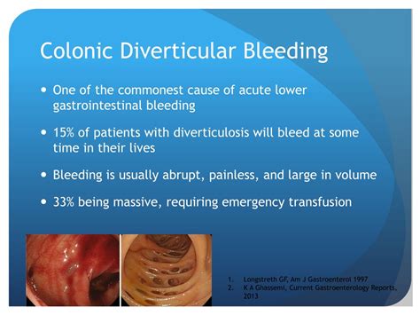 Ppt Colonic Diverticular Bleeding Causes Pathophysiology And