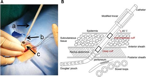 Ppt Insertion Of Peritoneal Dialysis Pd Catheter Powerpoint The Best