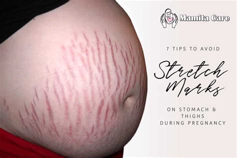 Pregnancy Stretch Marks