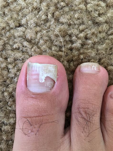 Premium Photo Broken Nail On Toe