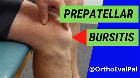 Prepatellar Bursitis Kneecap Bursitis Dr Mark Tuttle