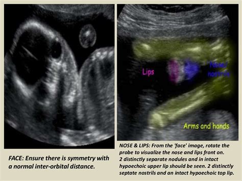 Presentation1 Pptx Ultrasound Examination Of The 2Nd 3Rd Trimester