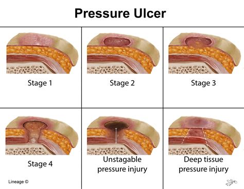 Pressure Ulcer Stages: Identify And Heal Faster