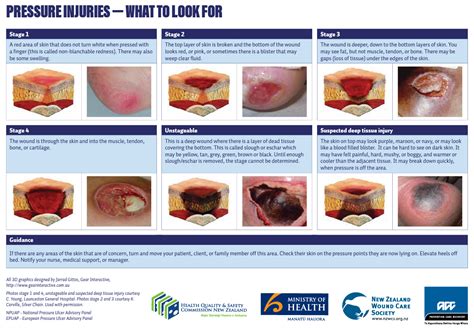 Pressure Ulcer Staging Chart Stages Of Pressure Injuries Pressure Ulcer