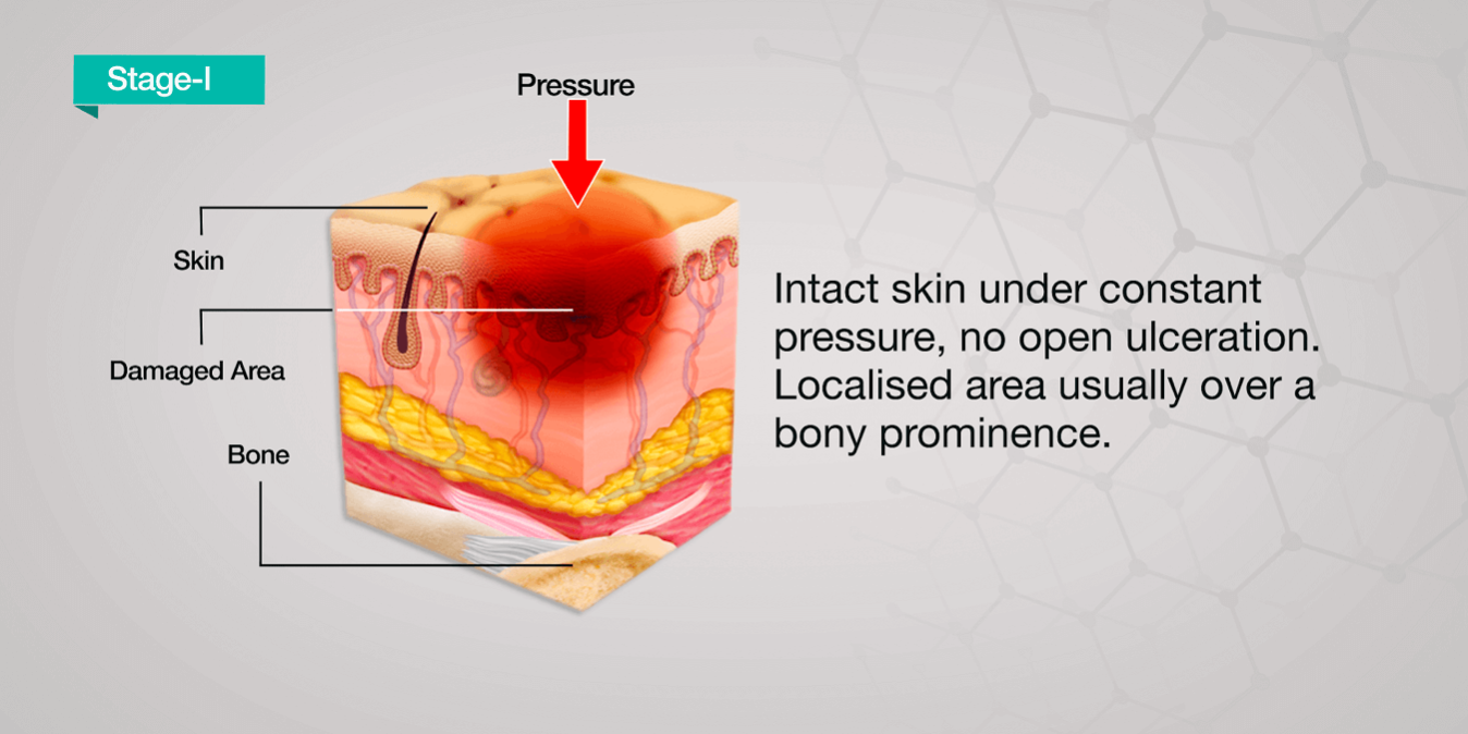 Pressure Ulcer Wound Healing Stages