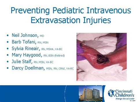 Preventing Pediatric Intravenous Extravasation Injuries Neil Johnson Md