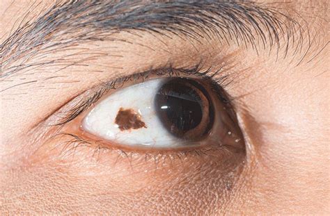 Primary Acquired Melanosis: Symptoms And Treatment