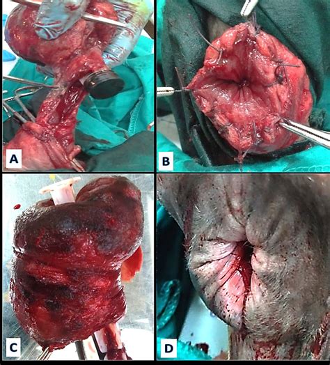 Prolapsed Bowel Images