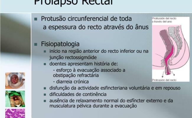 Prolapso Retal Humano Causas Braincp