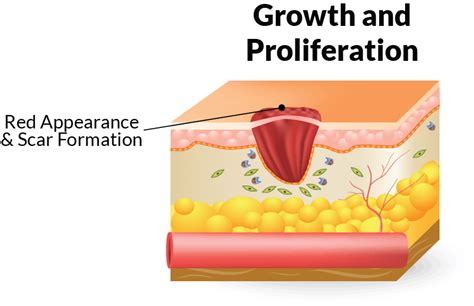 Proliferative Stage Of Wound Healing