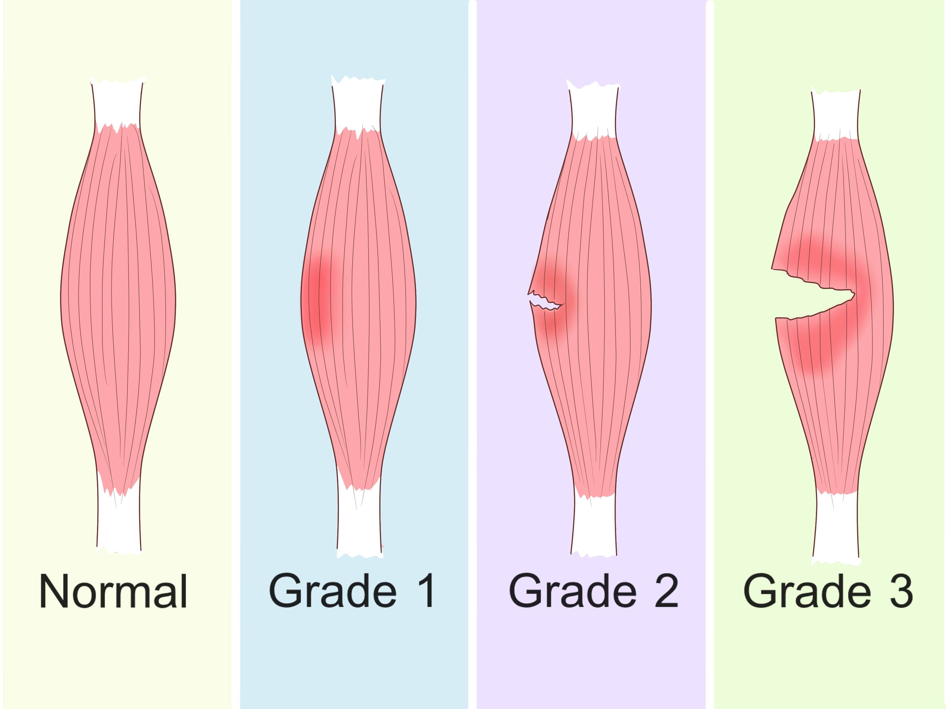 Pulled Quad Muscles Treating Quad Strain