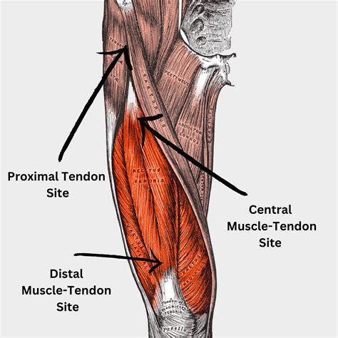 Pulled Quadriceps Muscle