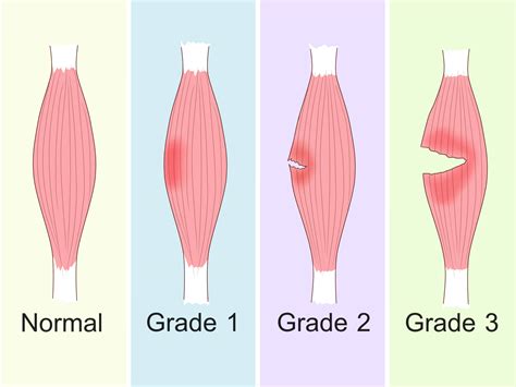 Quad Strain Relief: Diagnose And Treat