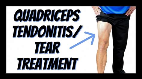 Quadriceps Tendonitis Or Tear Single Best Treatment You Can Do