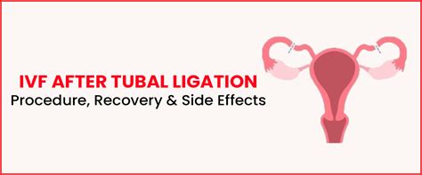 Recovery After Tubal Ligation