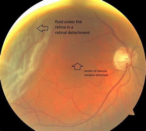 Recovery From Retinal Detachment