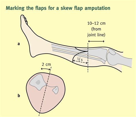 References In Amputation And Rehabilitation Surgery Oxford