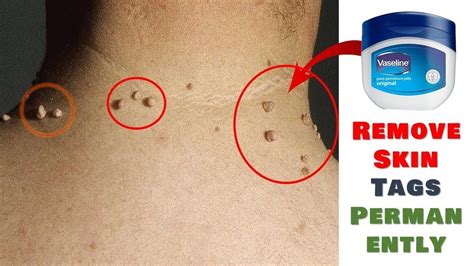 Remove Skin Tag In 1 Night By Applying Vaseline Youtube