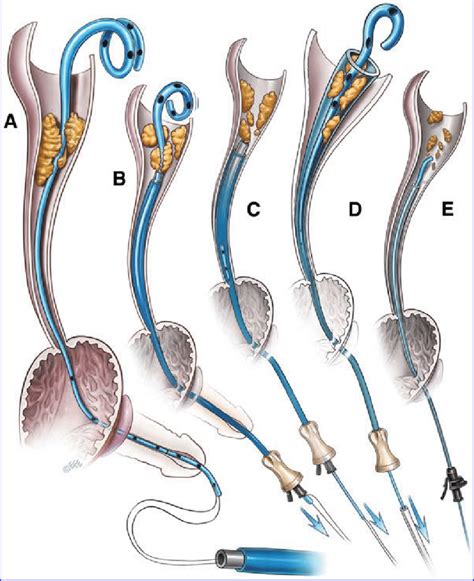 Removing Ureteral Stent