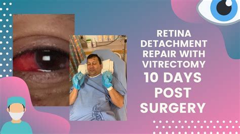 Retina Operation Recovery