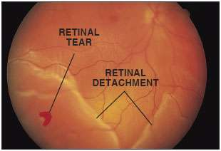 Retinal Detachment Recovery