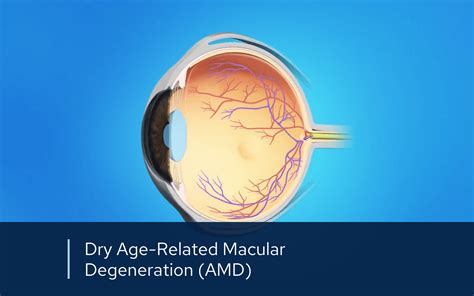 Retinal Videos Retinal Consultants Medical Group