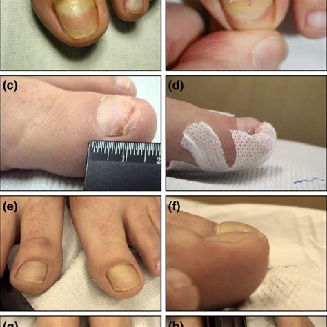 Retronychia With 6 Months Of Evolution B Day Of The Surgery This